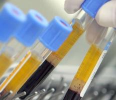 Advanced Lipid Test