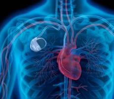 Pacemaker Defibrillators