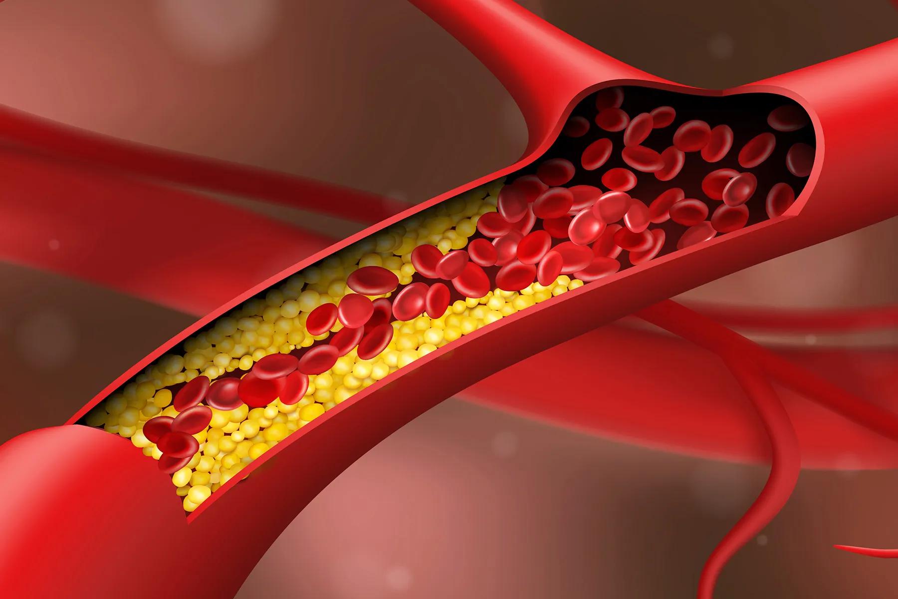 plaque-reversal-program-by-best-cardiologist-in-dubai