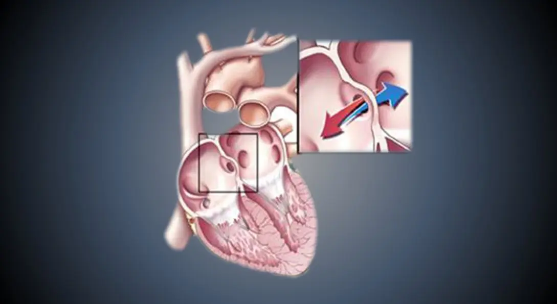symptoms-of-atrial-septal-defect